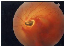 外傷性眼內炎 外傷性眼內炎