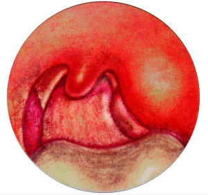 扁桃體周膿腫 扁桃體周膿腫