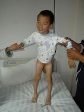 小兒腦性癱瘓 小兒腦性癱瘓