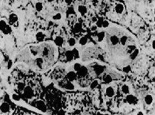 岩藻糖苷貯積症 岩藻糖苷貯積症