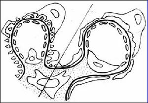 先天性腎病綜合徵
