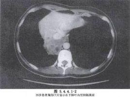 肺分離切除術 肺分離切除術