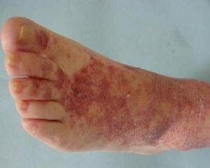 色素紫癜性皮炎 色素紫癜性皮炎