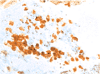 顯微鏡下多血管炎
