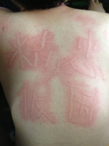 人工性蕁麻疹 人工性蕁麻疹