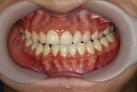 後牙反合 後牙反合