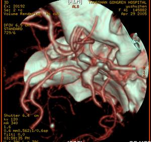 （圖）腦內動脈瘤