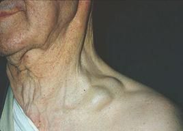 魏爾嘯淋巴結 魏爾嘯淋巴結