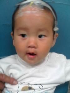 丙酸血症 丙酸血症