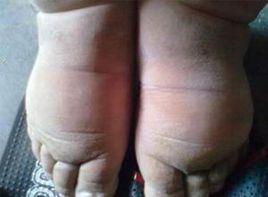 藥物性水腫 藥物性水腫