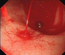 Dieulafoy胃黏膜糜爛 Dieulafoy胃黏膜糜爛