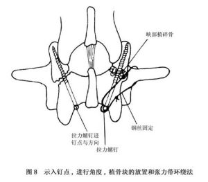 （圖）腰部峽部崩裂和脊椎滑脫