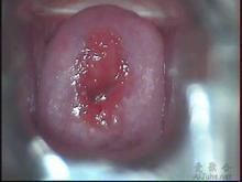 陰道加德納氏菌 陰道加德納氏菌