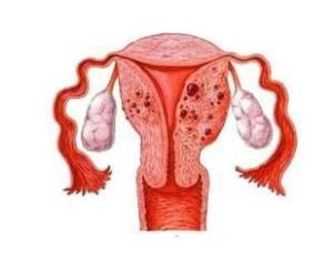 子宮腺肌症 子宮腺肌症