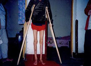 脊髓性肌萎縮 脊髓性肌萎縮