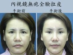 五爪拉皮 五爪拉皮