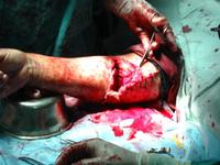 斷肢再植 斷肢再植