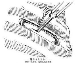 肺膿瘍引流術 肺膿瘍引流術