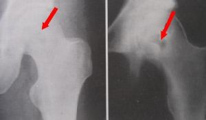 膿液培養 膿液培養