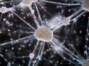 多發性骨髓瘤病腎病