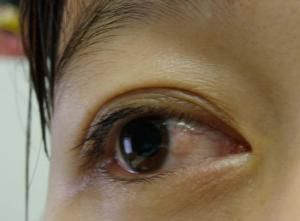 胬肉攀睛 胬肉攀睛