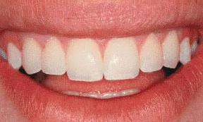 使用超薄牙貼面後