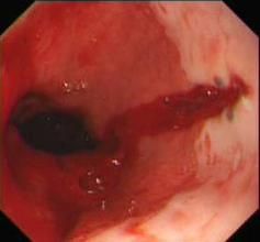 賁門黏膜撕裂綜合徵 賁門黏膜撕裂綜合徵