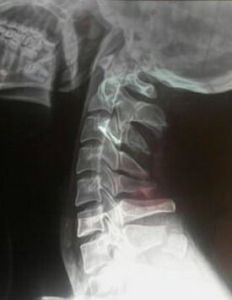 棘突骨折 棘突骨折