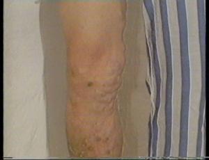 老年鈣化性瓣膜病