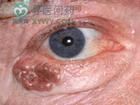 眼瞼癌 眼瞼癌