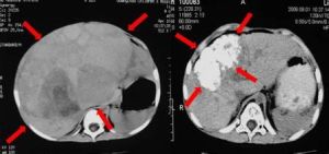 小兒肝母細胞瘤 小兒肝母細胞瘤