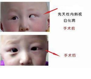 嬰幼兒型內斜視