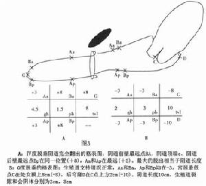 絕經期盆腔臟器脫垂
