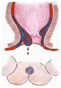 腸炎便血 腸炎便血