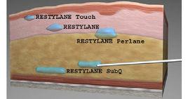 玻尿酸去皺 玻尿酸去皺