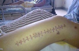 手術縫合線 手術縫合線