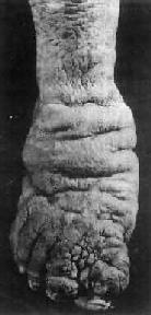 歐氏絲蟲病 歐氏絲蟲病