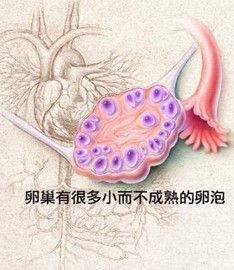 多囊性卵巢症候群