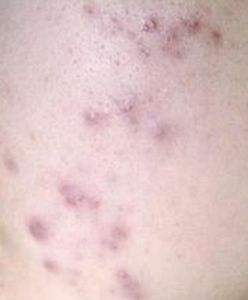 紅斑痤瘡 紅斑痤瘡