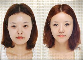 雙眼皮整容 雙眼皮整容