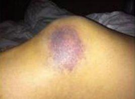 膝關節內側腫脹青紫,局部劇痛 膝關節內側腫脹青紫,局部劇痛