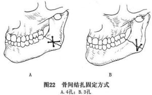 下頜骨表面咬肌剝離術 下頜骨表面咬肌剝離術