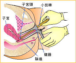 子宮頸