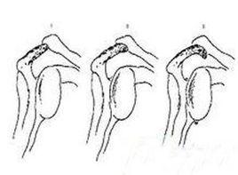 疼痛弧征 疼痛弧征