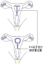 女性節育手術圖片