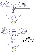 女性節育手術圖片