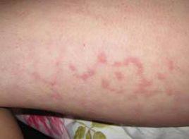 大腿內側紅斑 大腿內側紅斑