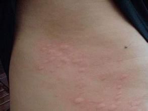 膽鹼性尋麻疹 膽鹼性尋麻疹