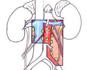 輸尿管腫瘤 輸尿管腫瘤