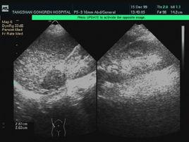 破骨細胞瘤 破骨細胞瘤